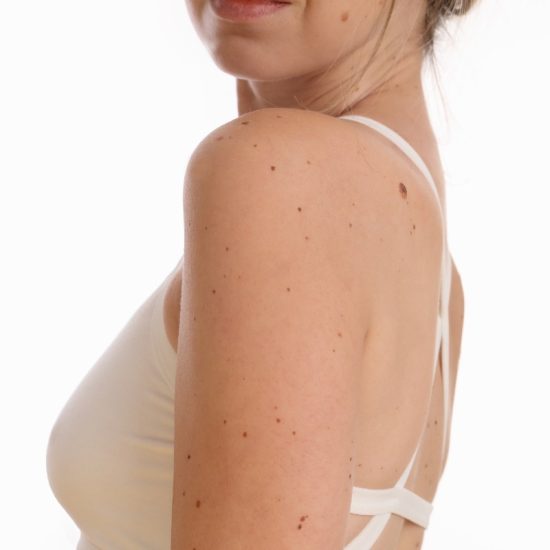 Skinfinity Skin Tag Remover: Testing Effectiveness & Safety (SMC Analysis Report)