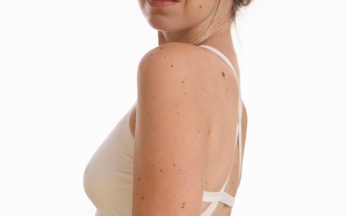 Skinfinity Skin Tag Remover: Testing Effectiveness & Safety (SMC Analysis Report)